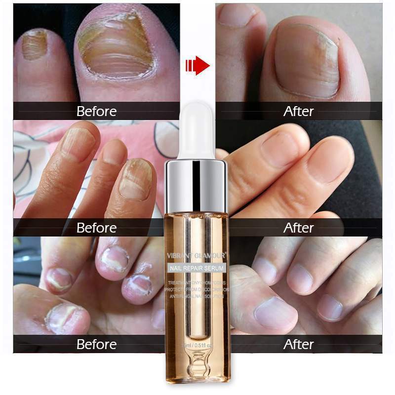 Professional Nail Repair Treatment